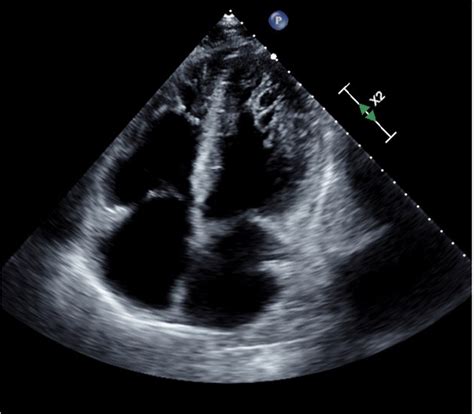 left ventricular ef 55 60